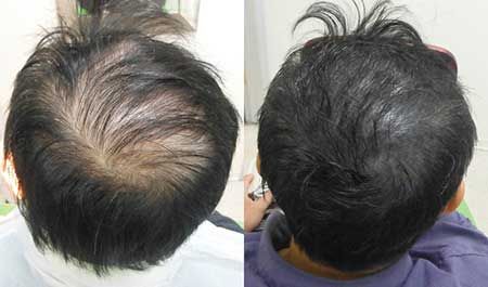 درمان کم پشتی مو با کوکتل ضد ریزش کلین بیوتی