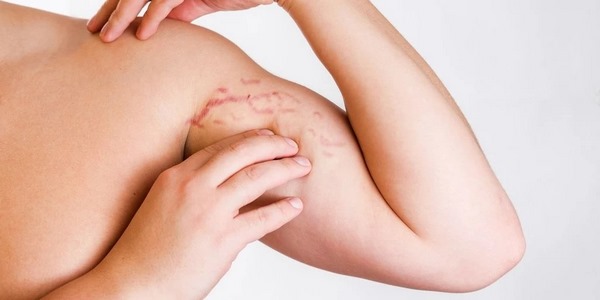 درمان طبیعی ترک پوستی 