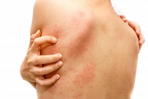 درمان حساسیت پوستی به لاتکس در خانه